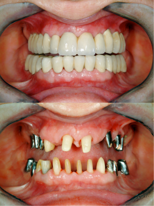 インプラントは「第3の歯」「第2の永久歯」と呼ばれています。